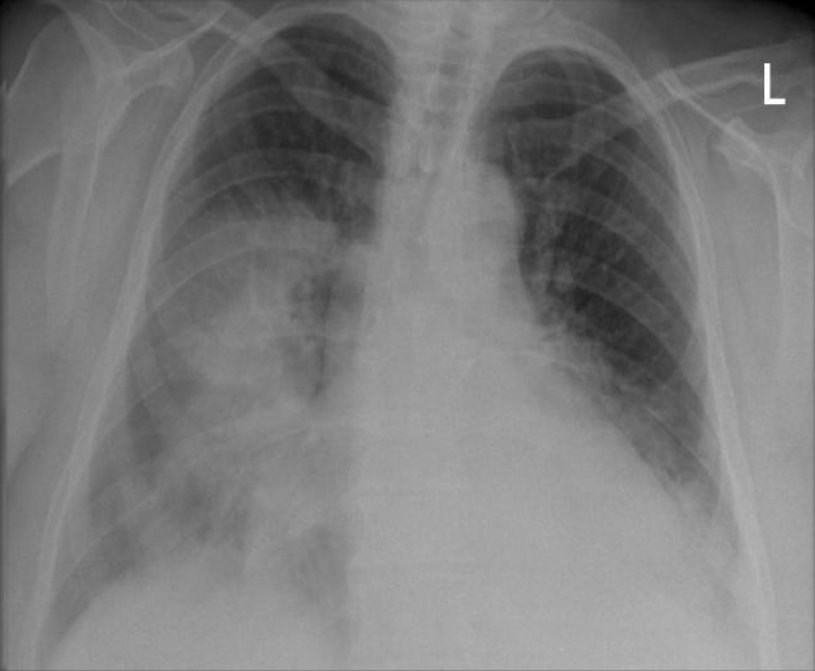 Chest X‑ray (PA view) showing consolidation in the right mid and both lower lobes, illustrative of pneumonia