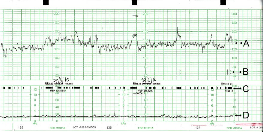 Cardiotocography (CTG) output showing fetal heartbeat, movements and uterine contractions